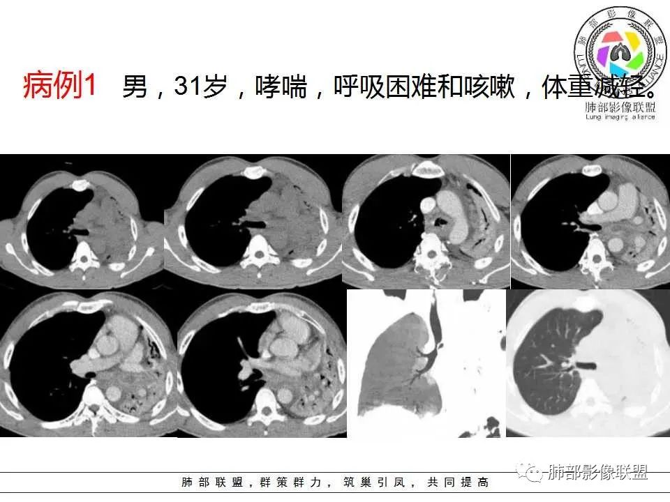 【PPT】侵袭性肺曲霉病影像分型及表现