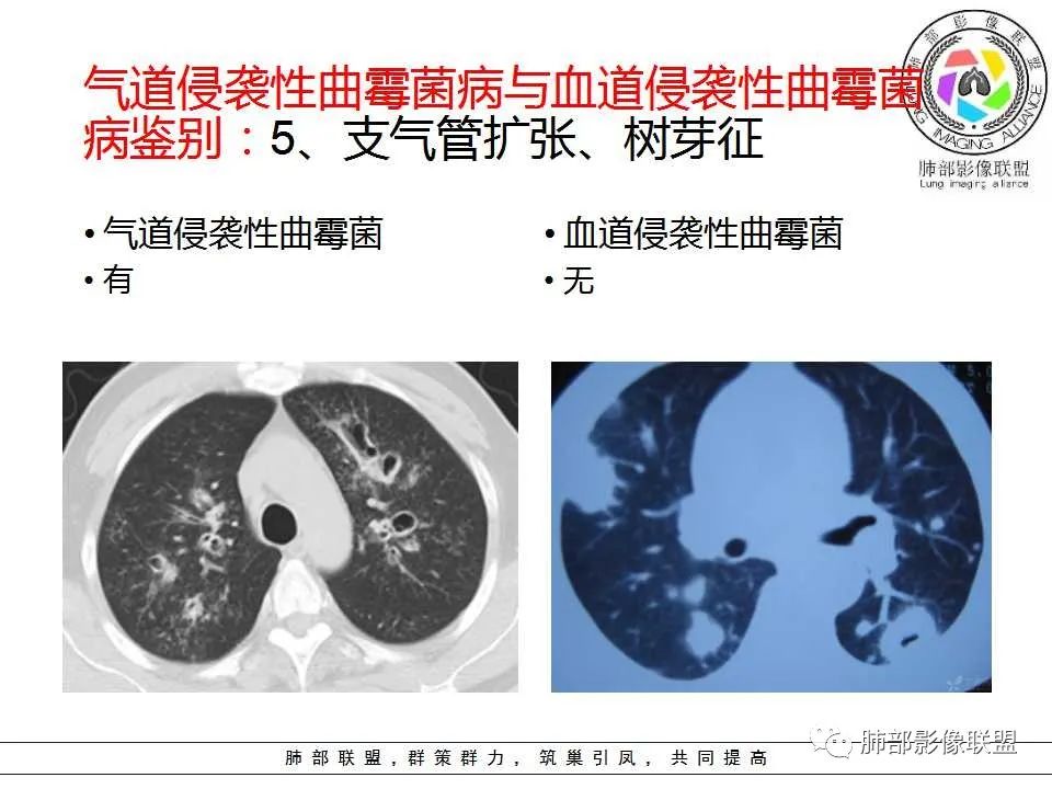 【PPT】侵袭性肺曲霉病影像分型及表现