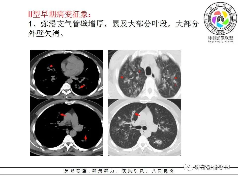 【PPT】侵袭性肺曲霉病影像分型及表现