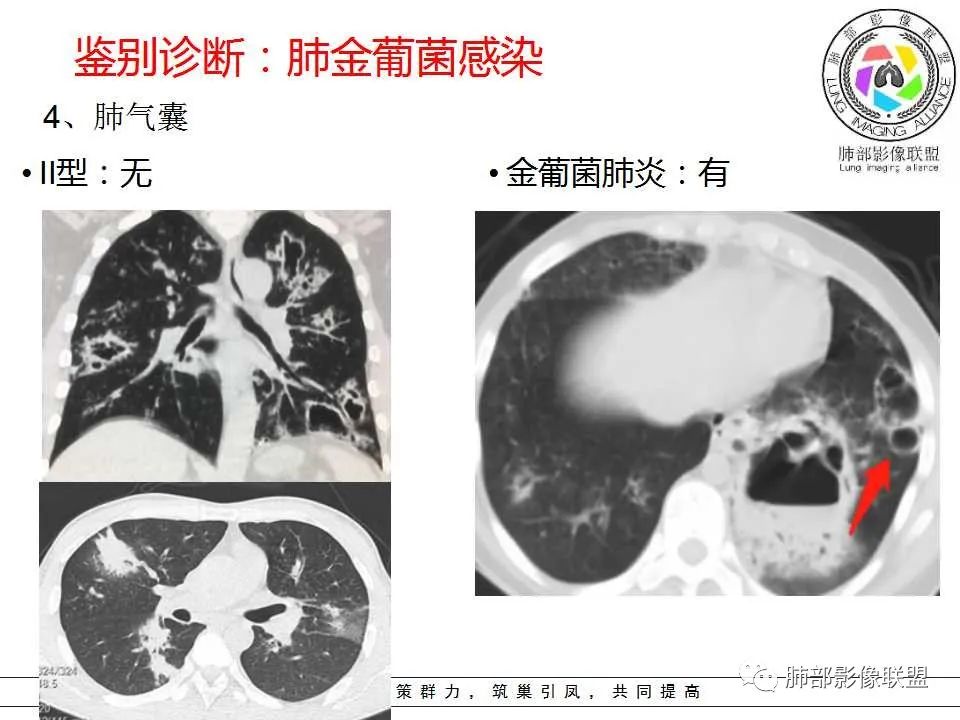 【PPT】侵袭性肺曲霉病影像分型及表现
