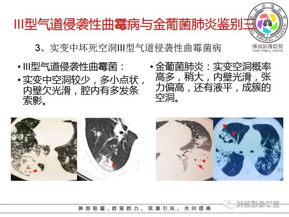 【PPT】侵袭性肺曲霉病影像分型及表现