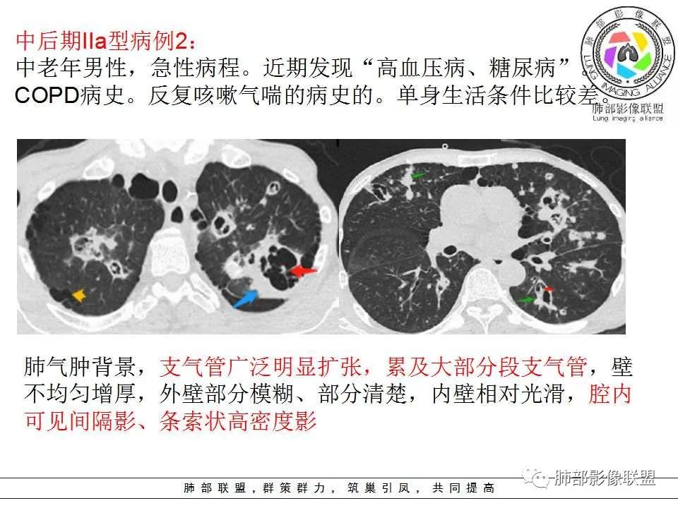 【PPT】侵袭性肺曲霉病影像分型及表现
