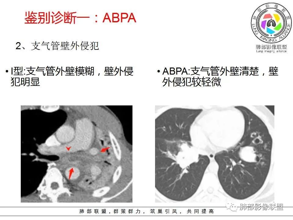 【PPT】侵袭性肺曲霉病影像分型及表现