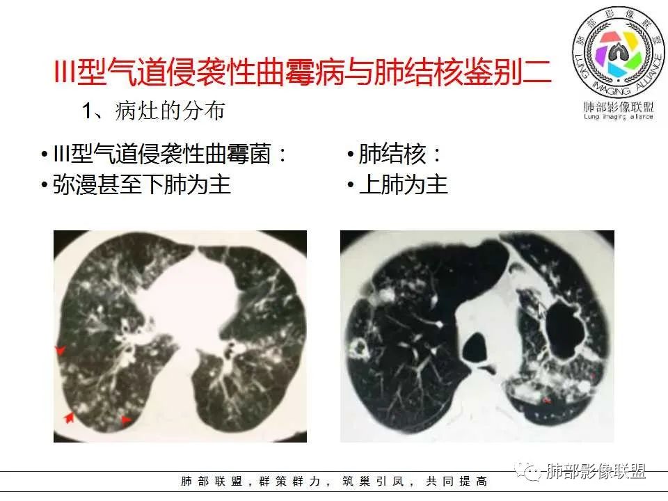 【PPT】侵袭性肺曲霉病影像分型及表现