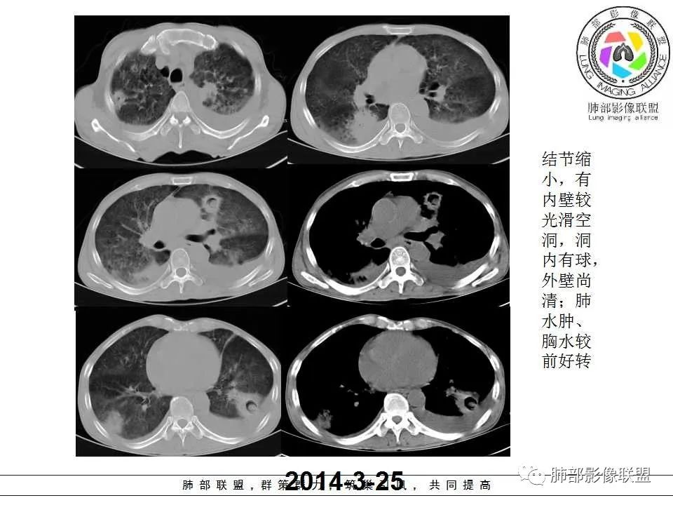 【PPT】侵袭性肺曲霉病影像分型及表现