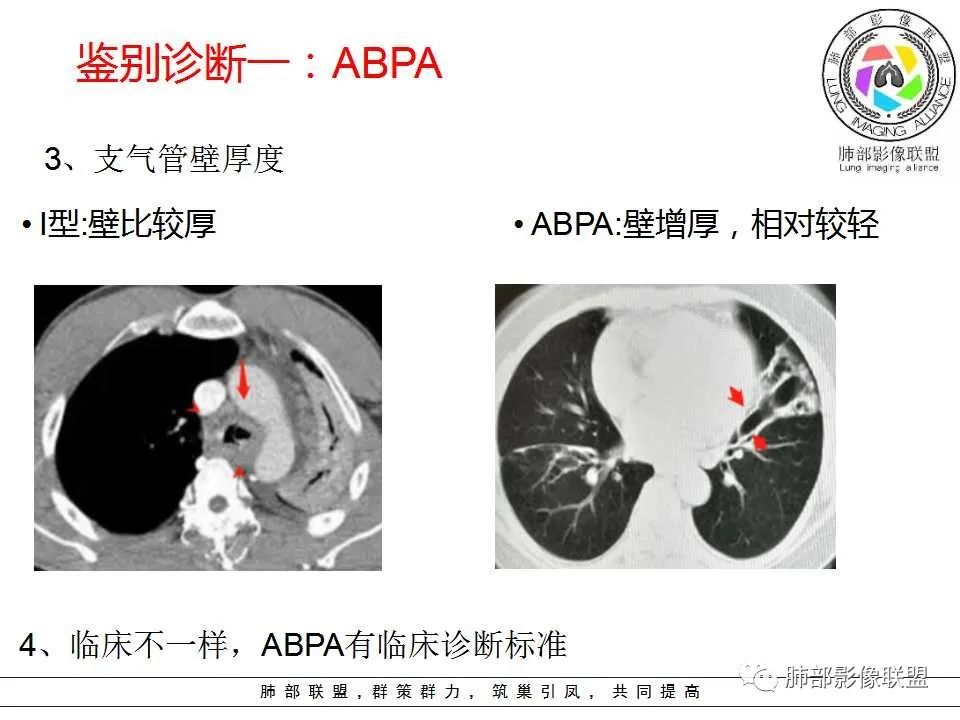 【PPT】侵袭性肺曲霉病影像分型及表现