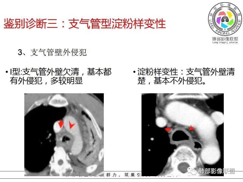 【PPT】侵袭性肺曲霉病影像分型及表现