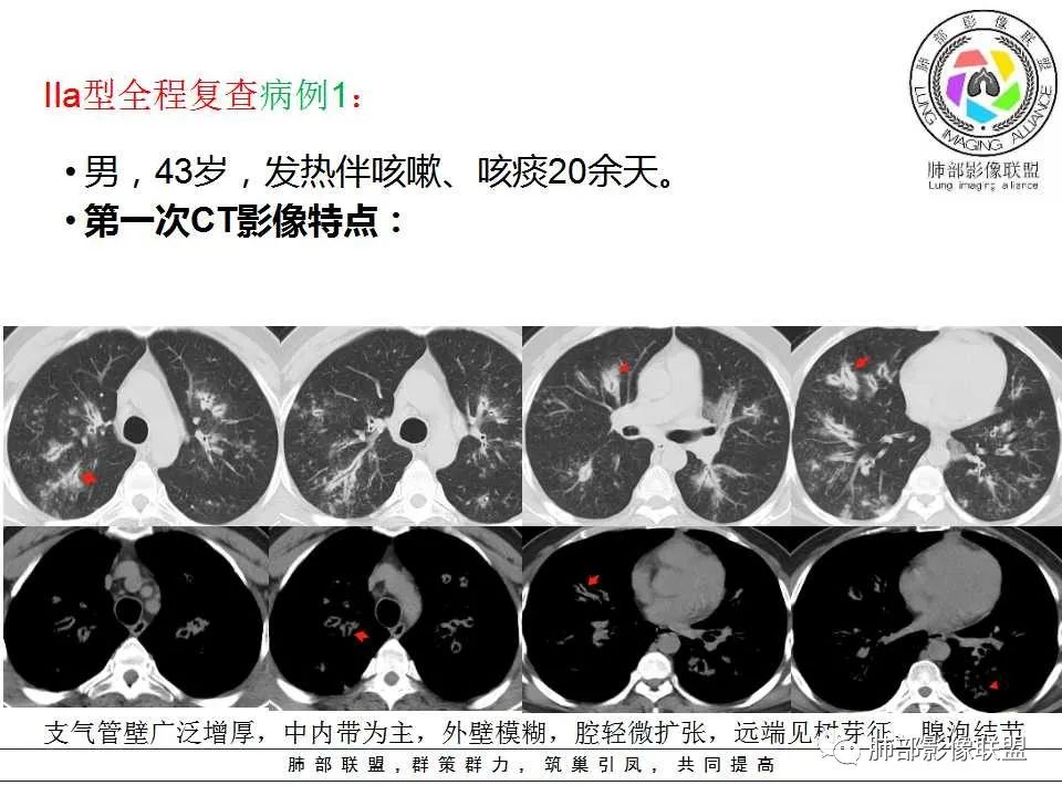 【PPT】侵袭性肺曲霉病影像分型及表现