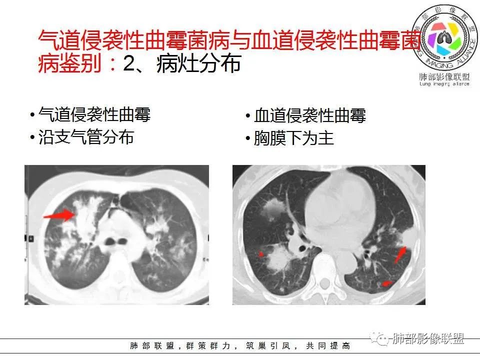 【PPT】侵袭性肺曲霉病影像分型及表现