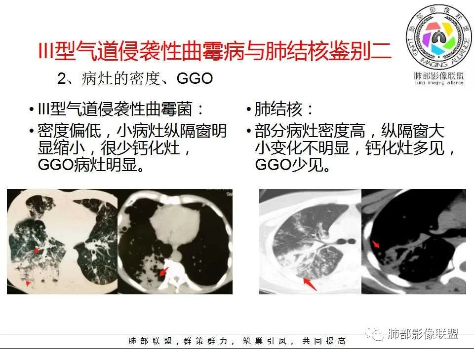 【PPT】侵袭性肺曲霉病影像分型及表现