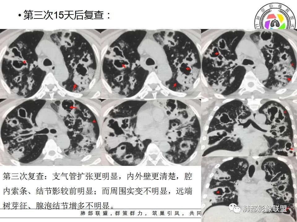 【PPT】侵袭性肺曲霉病影像分型及表现
