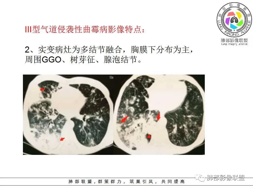 【PPT】侵袭性肺曲霉病影像分型及表现
