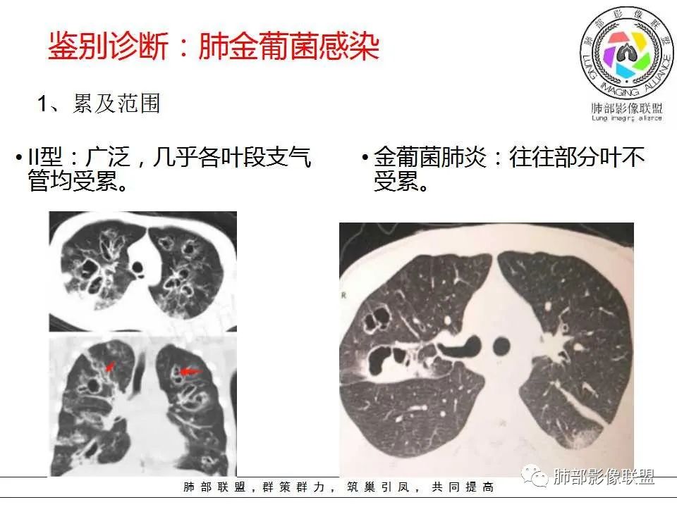 【PPT】侵袭性肺曲霉病影像分型及表现