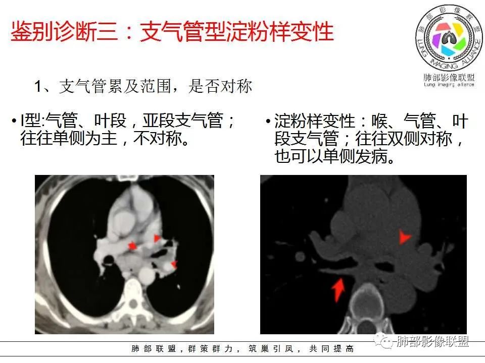 【PPT】侵袭性肺曲霉病影像分型及表现