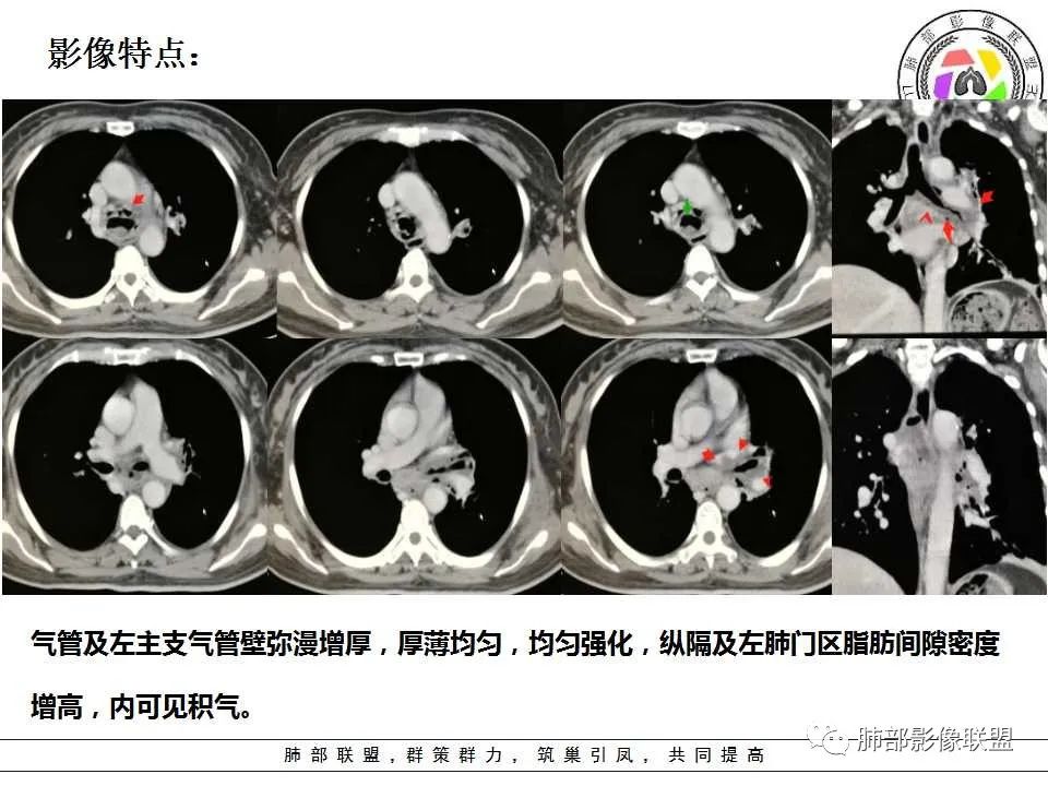 【PPT】侵袭性肺曲霉病影像分型及表现