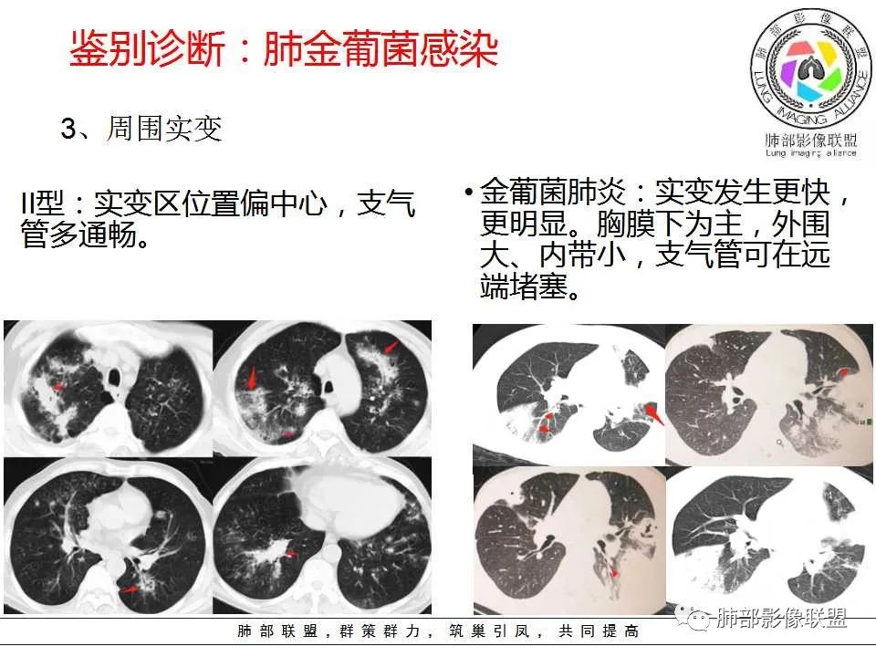 【PPT】侵袭性肺曲霉病影像分型及表现