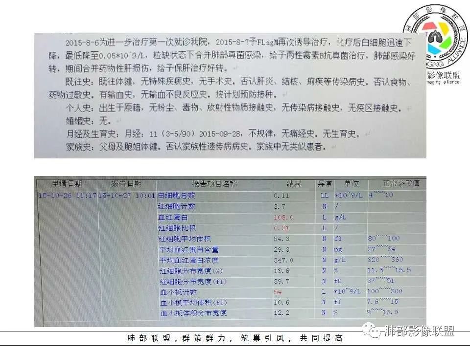 【PPT】侵袭性肺曲霉病影像分型及表现