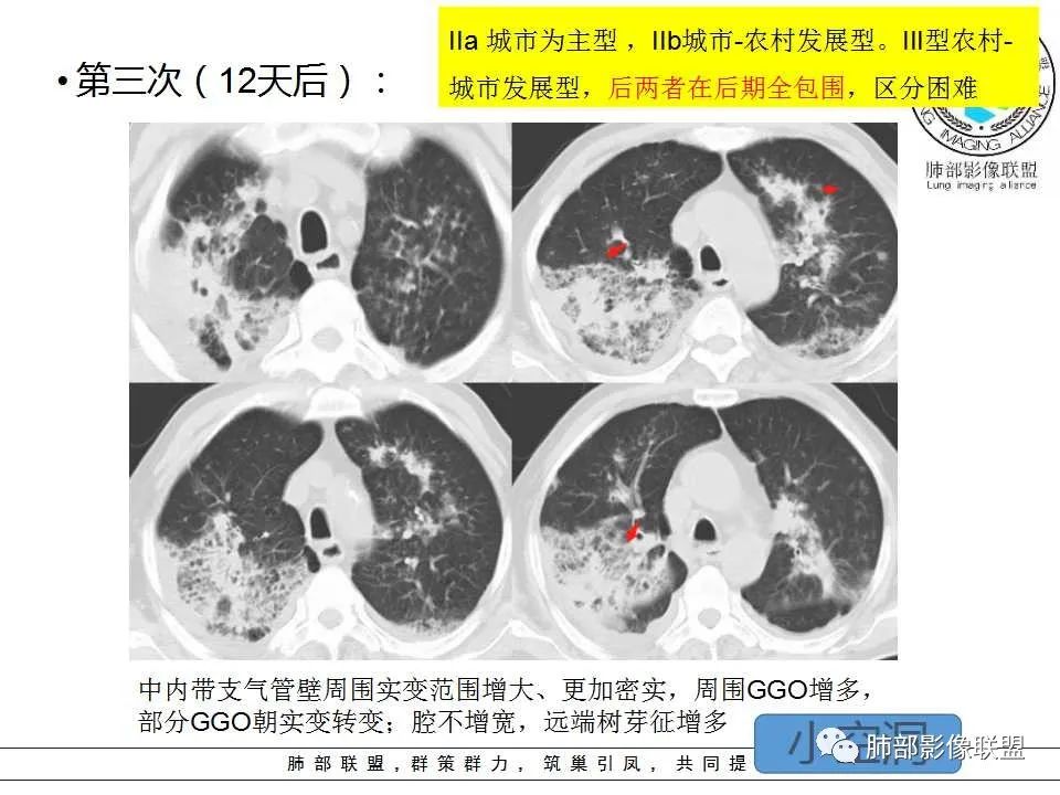 【PPT】侵袭性肺曲霉病影像分型及表现