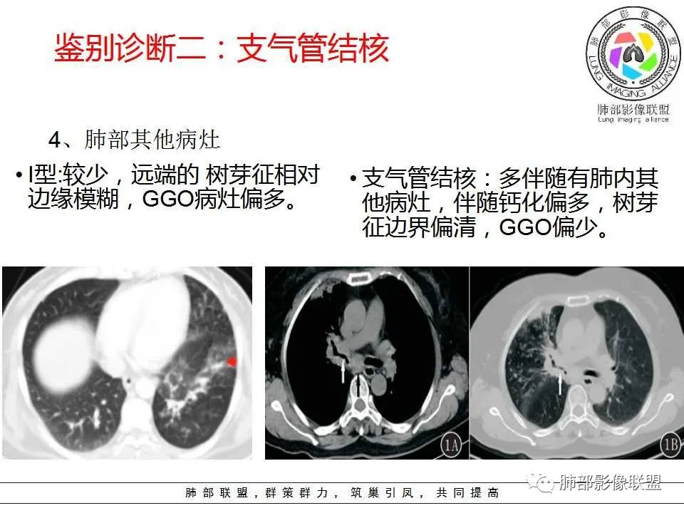 【PPT】侵袭性肺曲霉病影像分型及表现