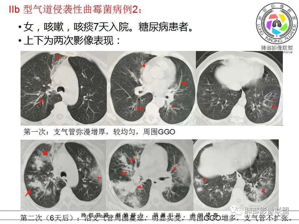 【PPT】侵袭性肺曲霉病影像分型及表现