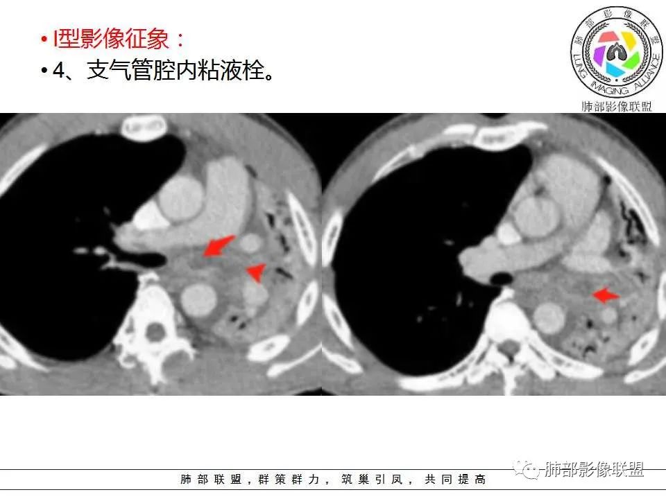 【PPT】侵袭性肺曲霉病影像分型及表现