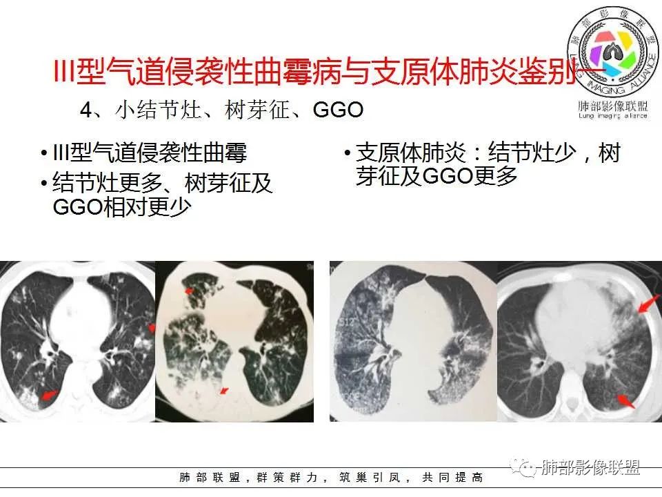 【PPT】侵袭性肺曲霉病影像分型及表现