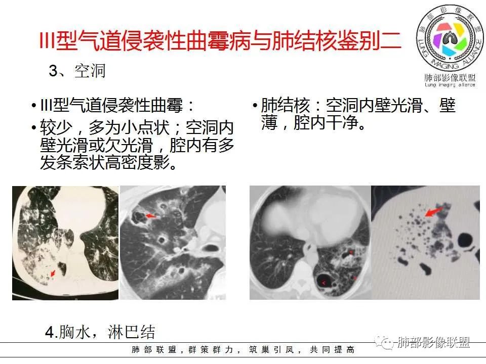 【PPT】侵袭性肺曲霉病影像分型及表现