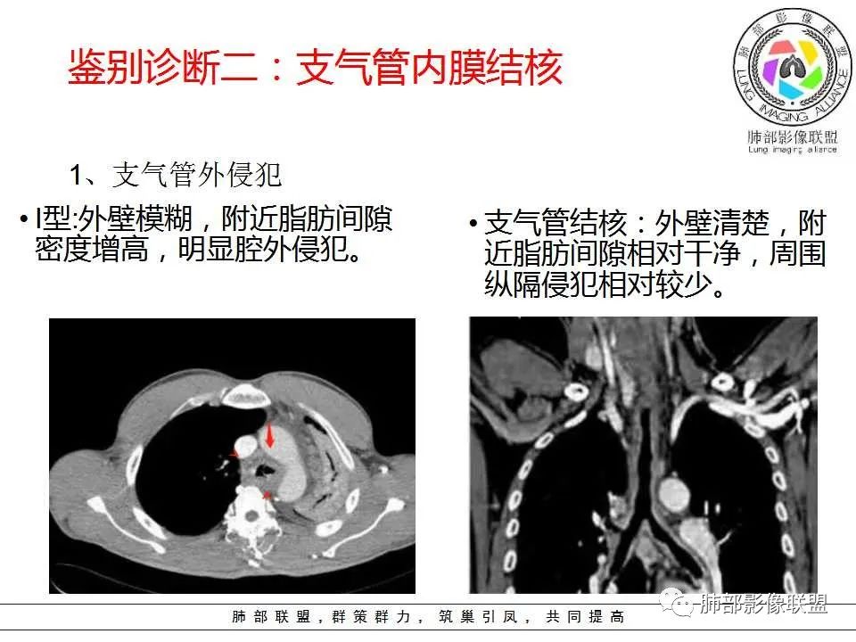 【PPT】侵袭性肺曲霉病影像分型及表现