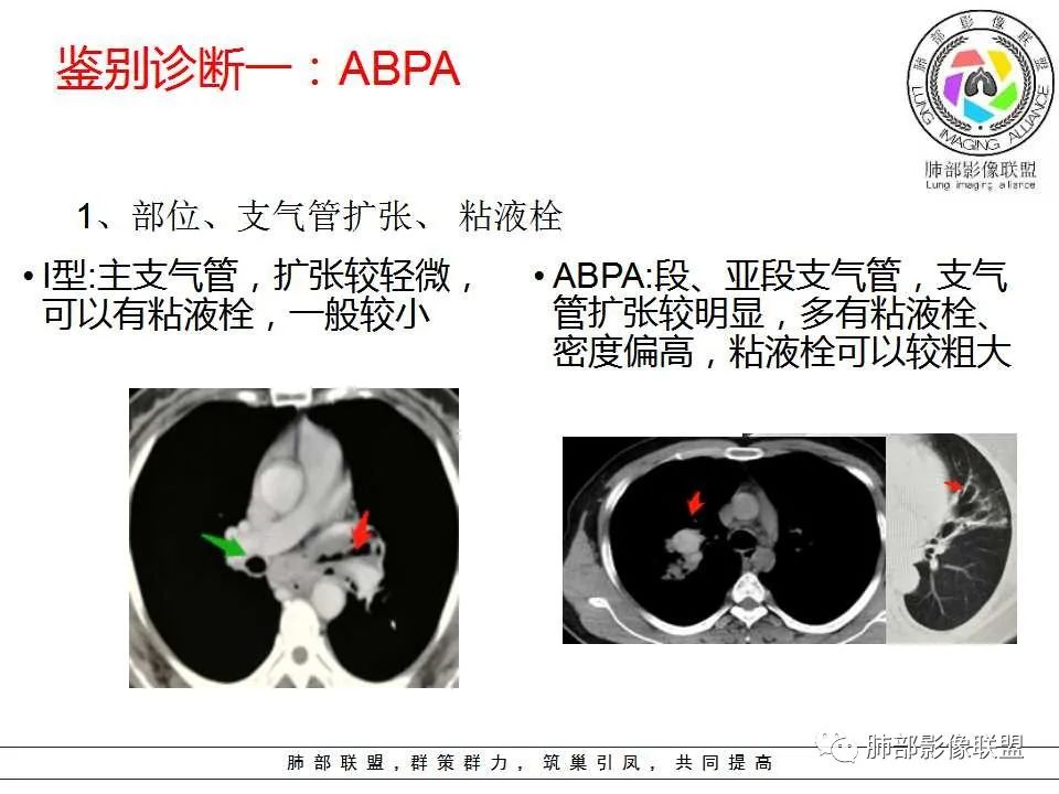 【PPT】侵袭性肺曲霉病影像分型及表现