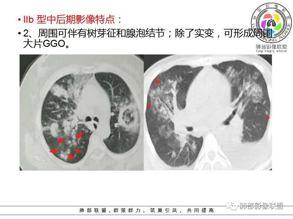 【PPT】侵袭性肺曲霉病影像分型及表现