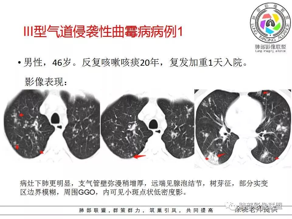【PPT】侵袭性肺曲霉病影像分型及表现