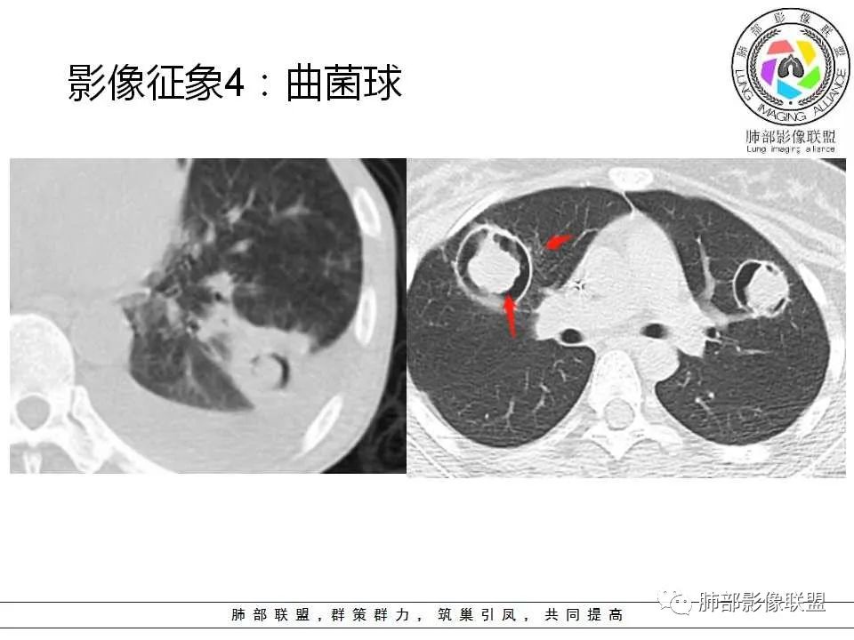 【PPT】侵袭性肺曲霉病影像分型及表现