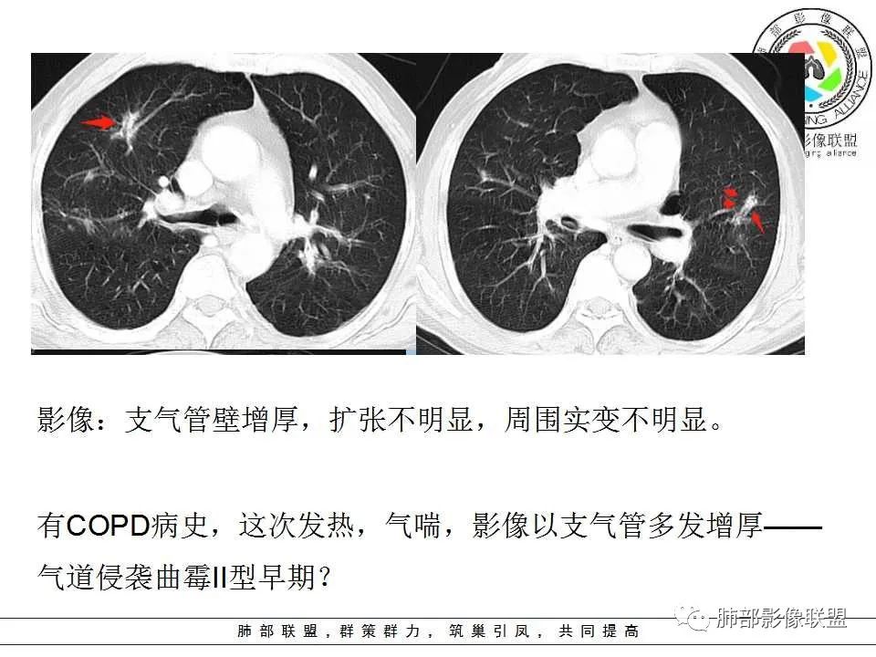 【PPT】侵袭性肺曲霉病影像分型及表现