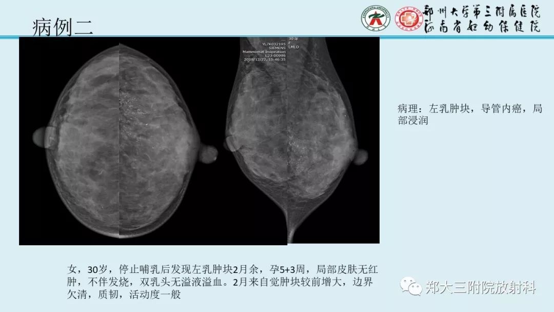 【PPT】妊娠相关乳腺癌的影像诊断