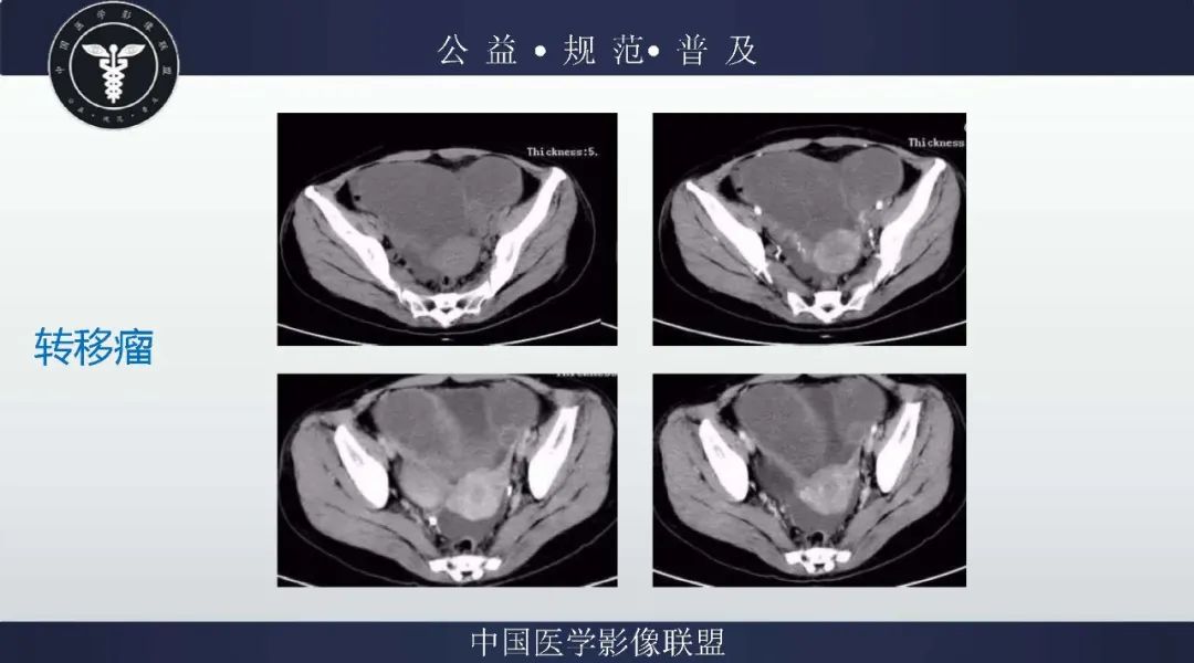 【病例】卵巢低级别浆液性囊腺癌1例CT及MR影像