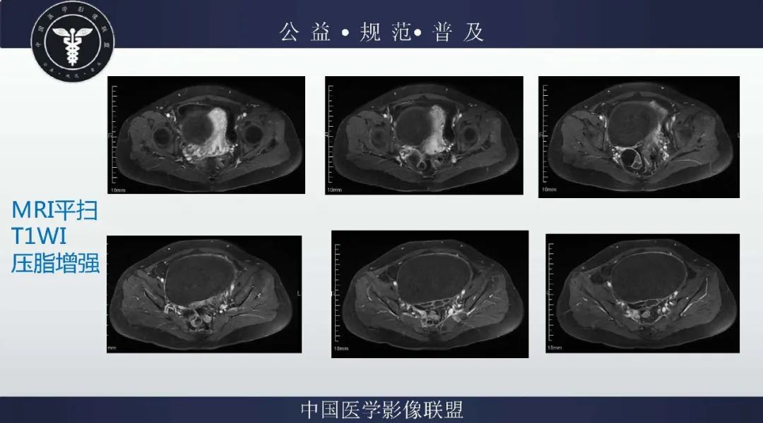 【病例】卵巢低级别浆液性囊腺癌1例CT及MR影像