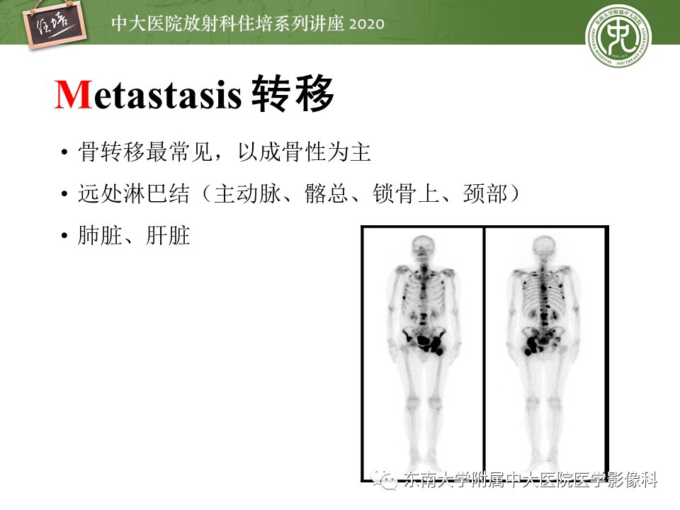 【PPT】MRI在前列腺癌TNM分期中的应用