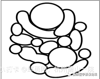 【病例】胰腺导管内乳头状粘液性肿瘤1例CT及MR影像 【病例】胰腺导管内乳头状粘液性肿瘤1例CT及MR影像