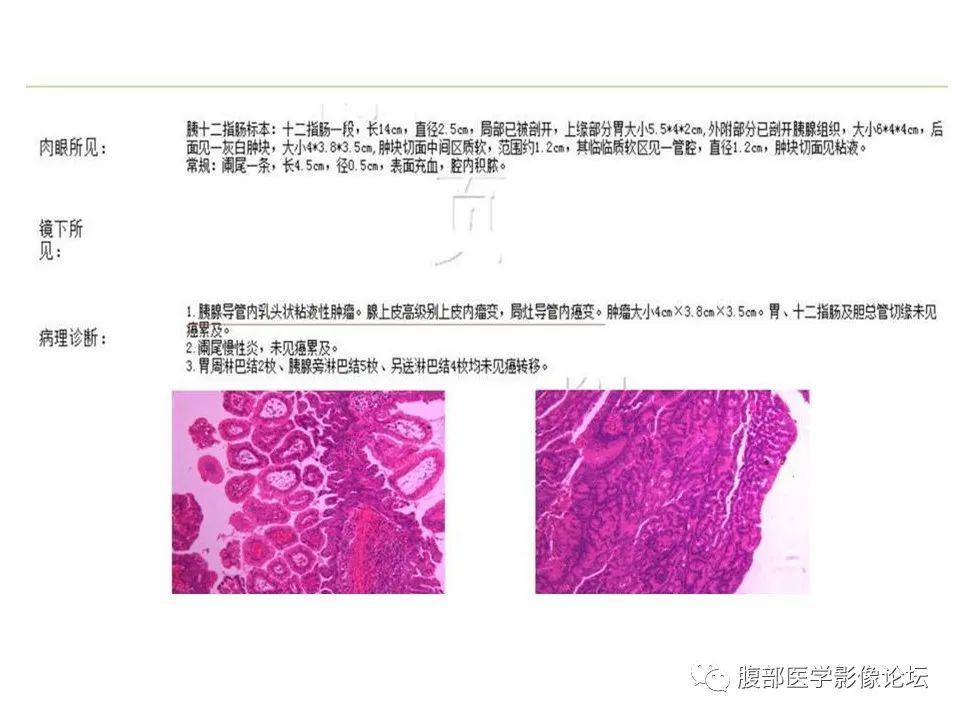 【病例】胰腺导管内乳头状粘液性肿瘤1例CT及MR影像