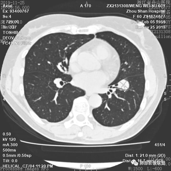 【病例】肺腺癌1例CT影像讨论