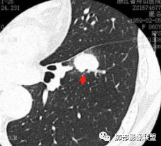 【病例】肺腺癌1例CT影像讨论