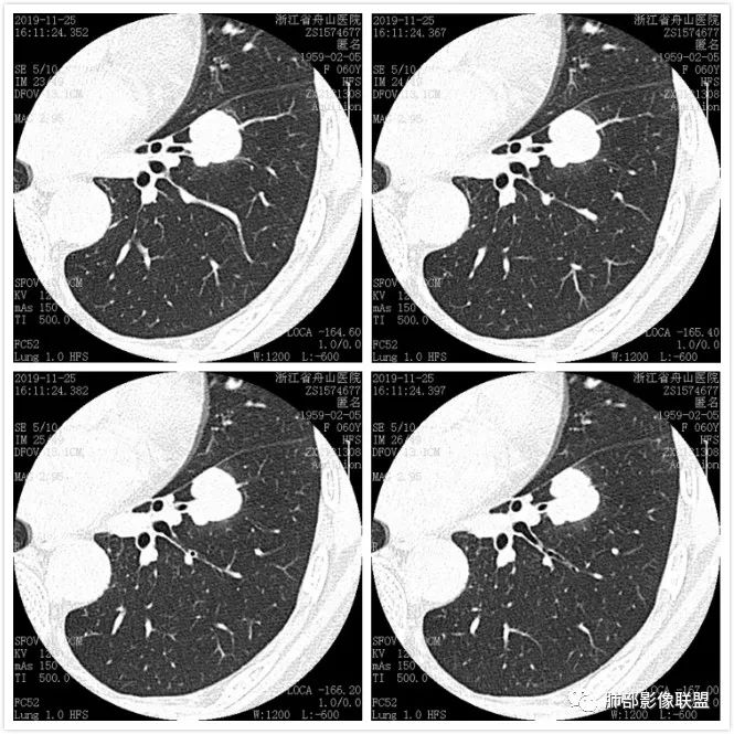 【病例】肺腺癌1例CT影像讨论