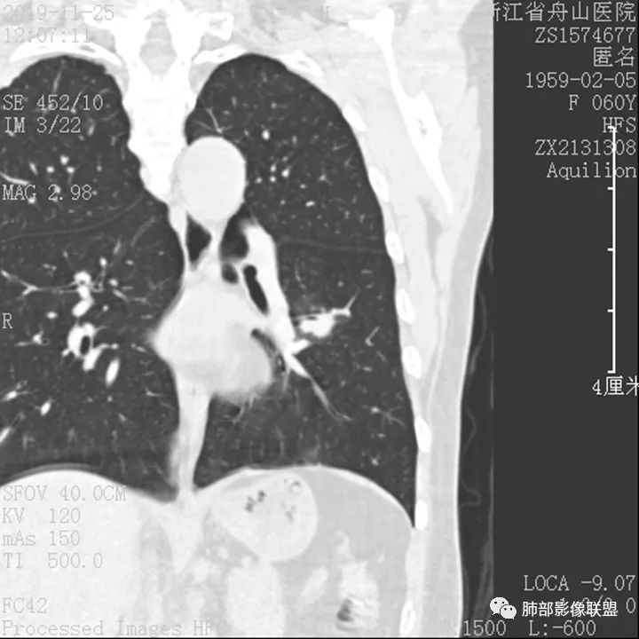 【病例】肺腺癌1例CT影像讨论