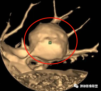 【病例】肺腺癌1例CT影像讨论