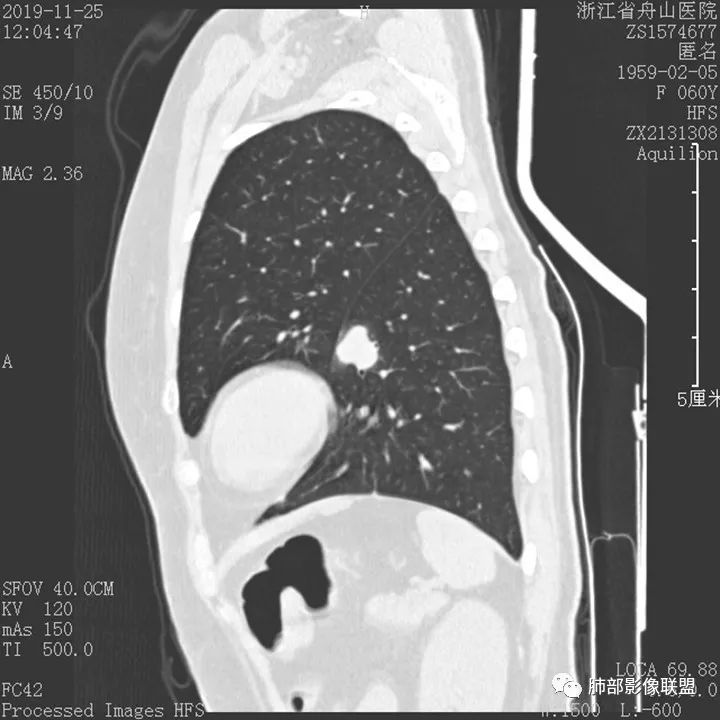 【病例】肺腺癌1例CT影像讨论