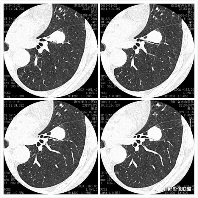 【病例】肺腺癌1例CT影像讨论