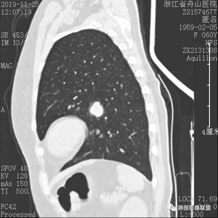 【病例】肺腺癌1例CT影像讨论