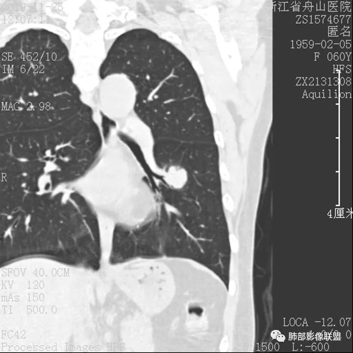 【病例】肺腺癌1例CT影像讨论