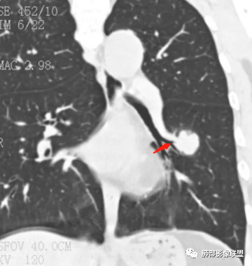【病例】肺腺癌1例CT影像讨论