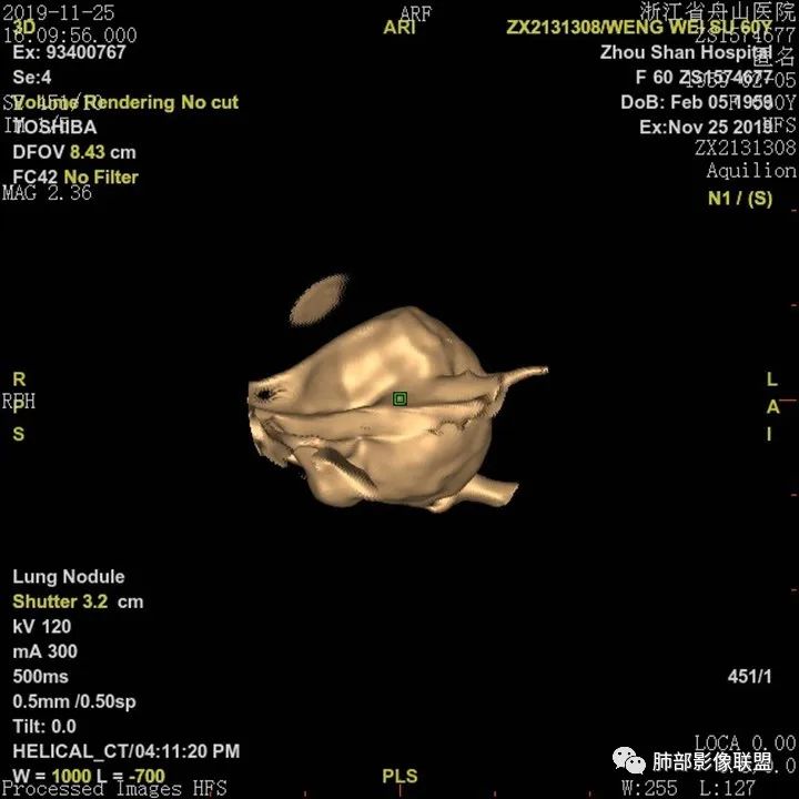 【病例】肺腺癌1例CT影像讨论